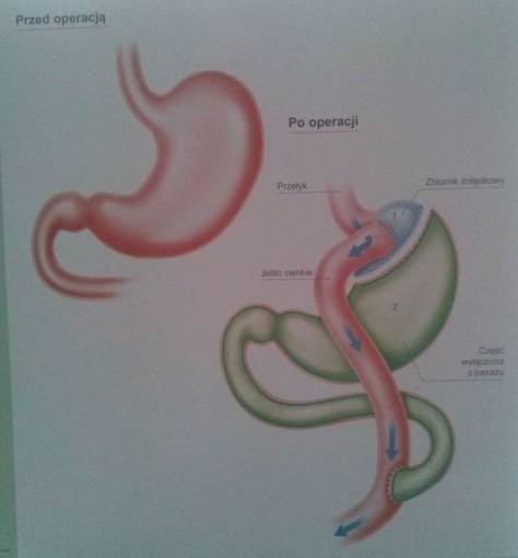 Gastric Bypass IKONA